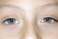 Congenital Left Upper Eyelid Ptosis Repair