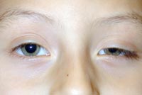 Congenital Left Upper Eyelid Ptosis Repair