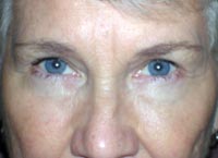 Bilateral Upper And Lower Eyelid Blepharoplasty