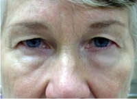 Bilateral Upper And Lower Eyelid Blepharoplasty