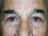 Bilateral Upper Eyelid Blepharoplasty