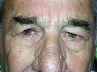 Bilateral Upper Eyelid Blepharoplasty