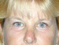 Endoscopic Eyebrow Lift; Bilateral Upper Eyelid Blepharoplasty; Bilateral Lower Eyelid Laser Resurfacing