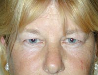 Endoscopic Eyebrow Lift; Bilateral Upper Eyelid Blepharoplasty; Bilateral Lower Eyelid Laser Resurfacing