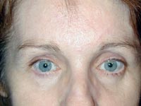 Endoscopic Eyebrow Lift