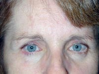 Endoscopic Eyebrow Lift