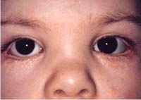 Bilateral Lower Eyelid Reconstruction And Euryblepharon Repair