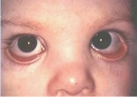 Bilateral Lower Eyelid Reconstruction And Euryblepharon Repair