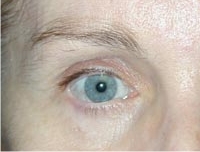 Right Lower Eyelid Basal Cell Cancer Removal And Reconstruction