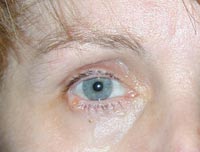 Right Lower Eyelid Basal Cell Cancer Removal And Reconstruction