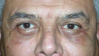 Bilateral Upper and Lower Eyelid Blepharoplasty; Bilateral Lower Eyelid Tightening