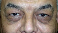 Bilateral Upper and Lower Eyelid Blepharoplasty; Bilateral Lower Eyelid Tightening