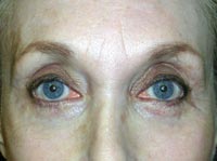 Bilateral Upper Eyelid Ptosis Repair And Blepharoplasty; Bilateral Lower Eyelid Blepharoplasty And Ectropion Repair; Endoscopic Brow Lift