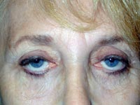 Bilateral Upper Eyelid Ptosis Repair And Blepharoplasty; Bilateral Lower Eyelid Blepharoplasty And Ectropion Repair; Endoscopic Brow Lift