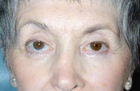 Full Face Laser Resurfacing; Left Upper Eyelid Ptosis Repair; Bilateral Upper Eyelid Blepharoplasty; Bilateral Lower Eyelid Blepharoplasty