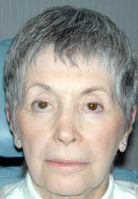 Full Face Laser Resurfacing; Left Upper Eyelid Ptosis Repair; Bilateral Upper Eyelid Blepharoplasty; Bilateral Lower Eyelid Blepharoplasty