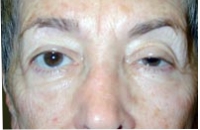 Full Face Laser Resurfacing; Left Upper Eyelid Ptosis Repair; Bilateral Upper Eyelid Blepharoplasty; Bilateral Lower Eyelid Blepharoplasty