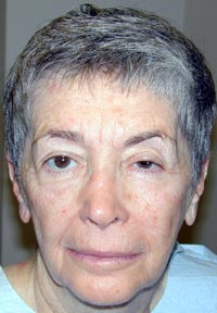 Full Face Laser Resurfacing; Left Upper Eyelid Ptosis Repair; Bilateral Upper Eyelid Blepharoplasty; Bilateral Lower Eyelid Blepharoplasty
