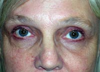 Bilateral Lower Eyelid Ectropion Repair And Blepharoplasty