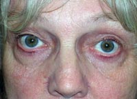 Bilateral Lower Eyelid Ectropion Repair And Blepharoplasty