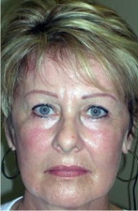 Endoscopic Eyebrow Lift; Bilateral Upper Eyelid And Lower Eyelid Blepharoplasty; Full Face Laser Resurfacing