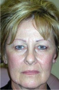 Endoscopic Eyebrow Lift; Bilateral Upper Eyelid And Lower Eyelid Blepharoplasty; Full Face Laser Resurfacing