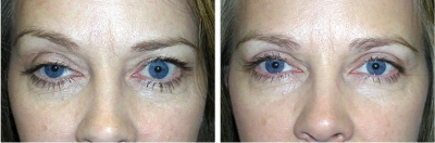 Right Upper Eyelid Ptosis Repair; Bilateral Upper Eyelid Blepharoplasty
