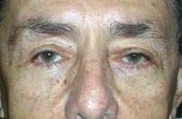 Bilateral Lower Eyelid Blepharoplasty; Bilateral Lower Eyelid Ectropion Repair