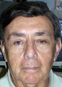 Bilateral Lower Eyelid Blepharoplasty; Bilateral Lower Eyelid Ectropion Repair