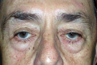Bilateral Lower Eyelid Blepharoplasty; Bilateral Lower Eyelid Ectropion Repair