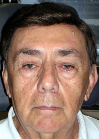 Bilateral Lower Eyelid Blepharoplasty; Bilateral Lower Eyelid Ectropion Repair