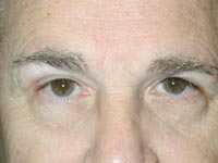 Bilateral Upper Eyelid Blepharoplasty