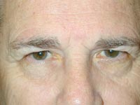 Bilateral Upper Eyelid Blepharoplasty