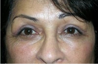 Bilateral Upper Eyelid Ptosis Repair and Blepharoplasty