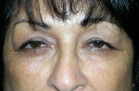Bilateral Upper Eyelid Ptosis Repair and Blepharoplasty