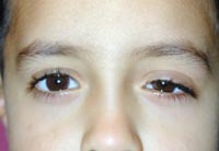 Congenital Left Upper Eyelid Ptosis Repair