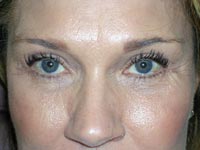 Midface Lift; Bilateral Upper Eyelid Blepharoplasty; Bilateral Lower Eyelid Blepharoplasty; Bilateral Lower Eyelid Ectropion Repair
