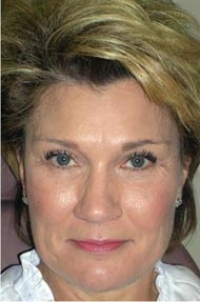 Midface Lift; Bilateral Upper Eyelid Blepharoplasty; Bilateral Lower Eyelid Blepharoplasty; Bilateral Lower Eyelid Ectropion Repair