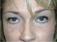 Midface Lift; Bilateral Upper Eyelid Blepharoplasty; Bilateral Lower Eyelid Blepharoplasty; Bilateral Lower Eyelid Ectropion Repair