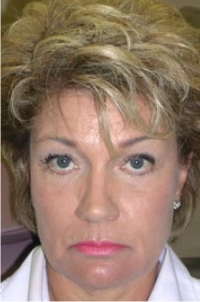 Midface Lift; Bilateral Upper Eyelid Blepharoplasty; Bilateral Lower Eyelid Blepharoplasty; Bilateral Lower Eyelid Ectropion Repair