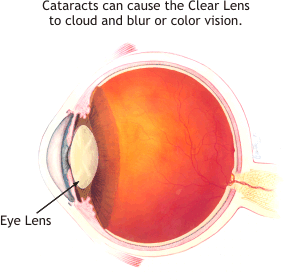 cataract clouding of eye lens